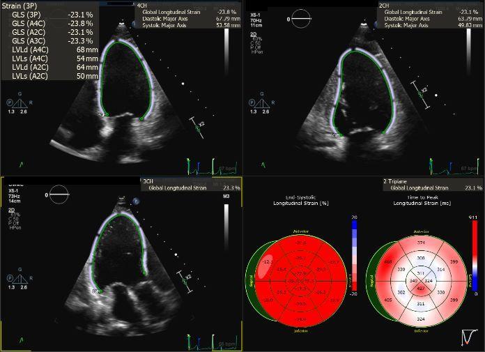 Sonographic image of cardiac strain